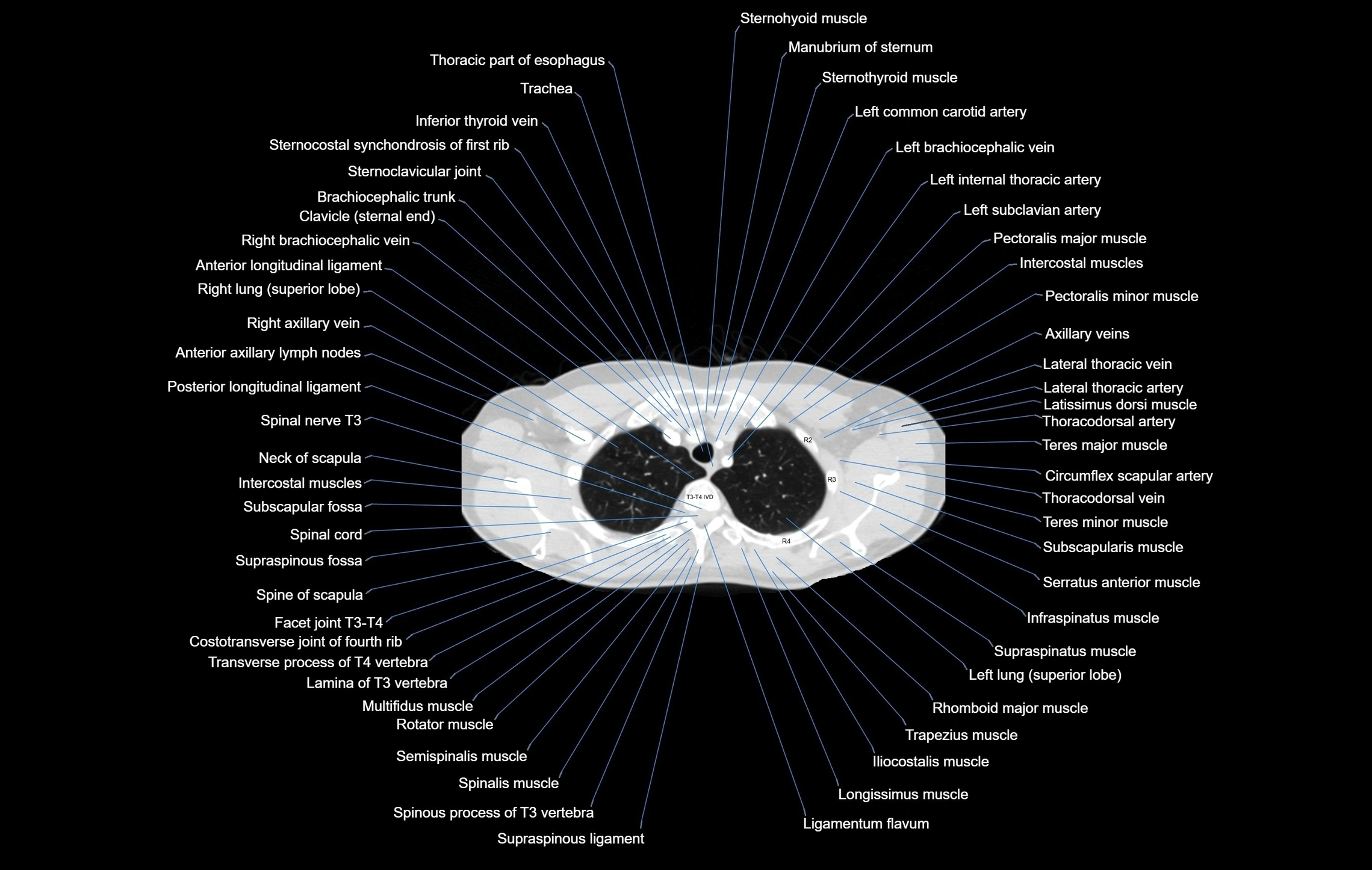 CT chest (thorax) lung window window labelled axial cross sectional anatomy radiology image-00021.webp